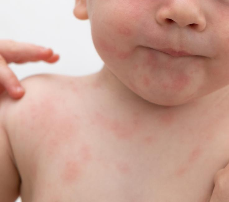Aprende a reconocer y tratar las alergias alimentarias en niños. Identifica los síntomas, descubre consejos para evitar los alérgenos y manejar las reacciones.